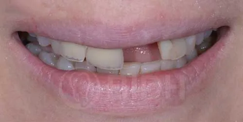 single tooth implant Thailand,Thailand missing tooth replacement,single dental implant case study