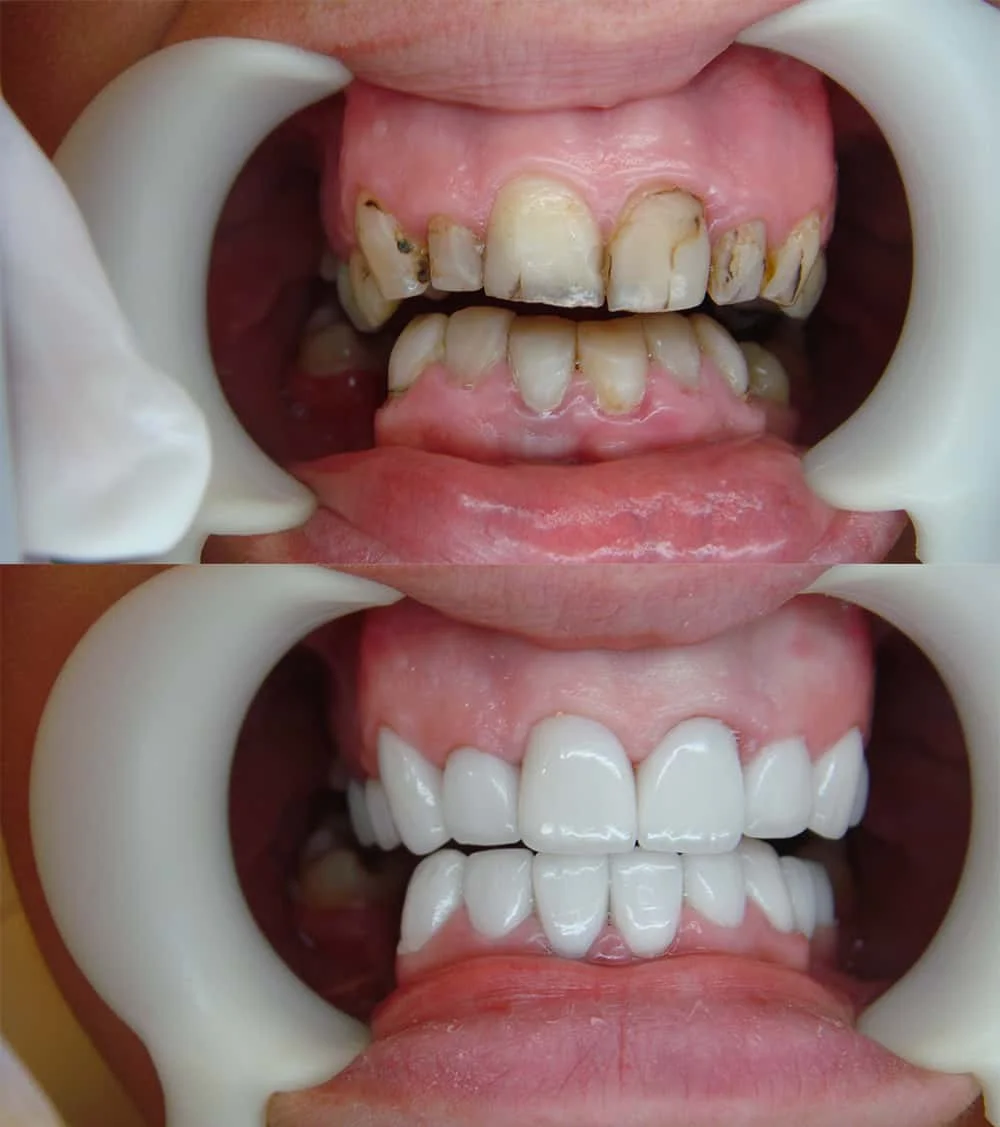 dental crown restoration Thailand,cosmetic dentistry case Thailand,tooth crown before after