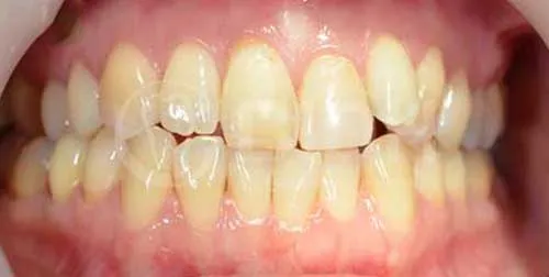 single tooth whitening Thailand,Thailand orthodontic correction,Thailand cosmetic dental treatment