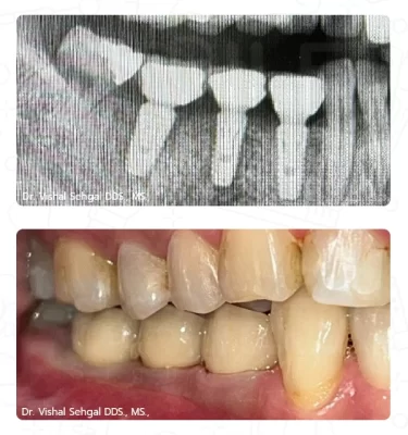After Treatment