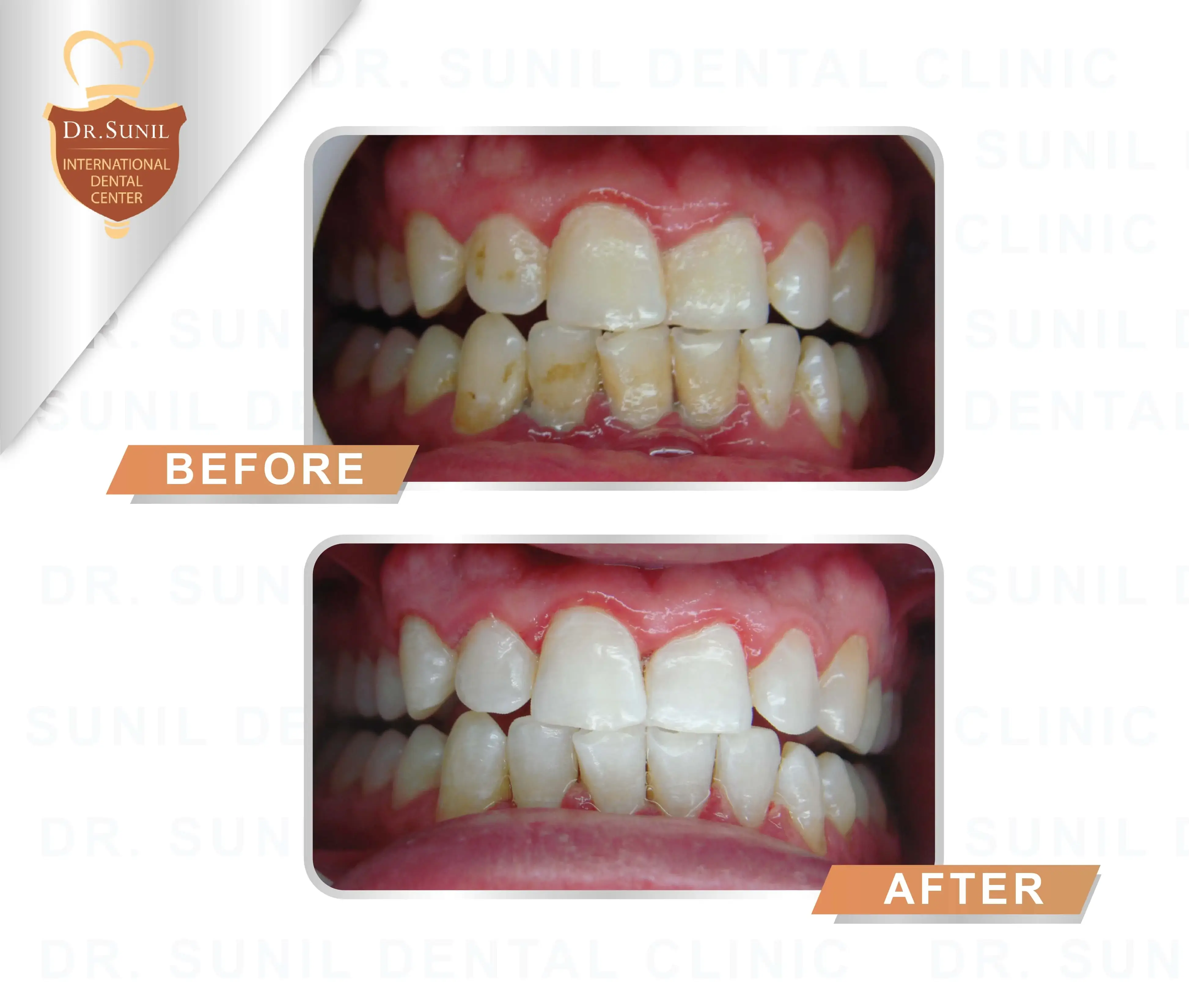 teeth whitening Thailand,cosmetic dentistry case Thailand,dentist teeth whitening case study