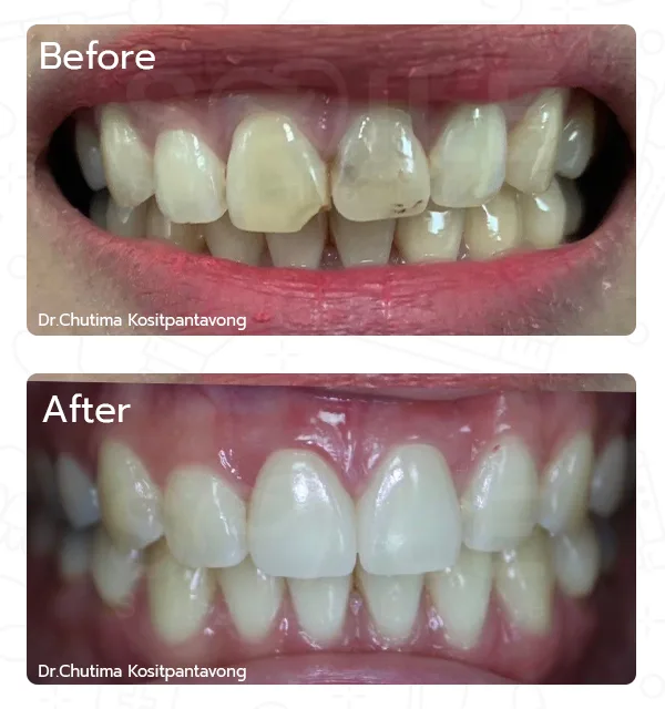 porcelain veneer case,dental veneer treatment,cosmetic dentistry case,smile makeover veneers