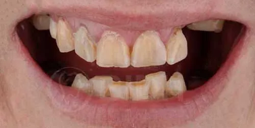 Thailand dental implant case,Bangkok tooth replacement with crown,dental implant and crown restoration Thailand