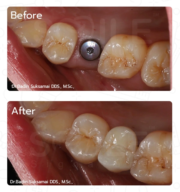 After Treatment