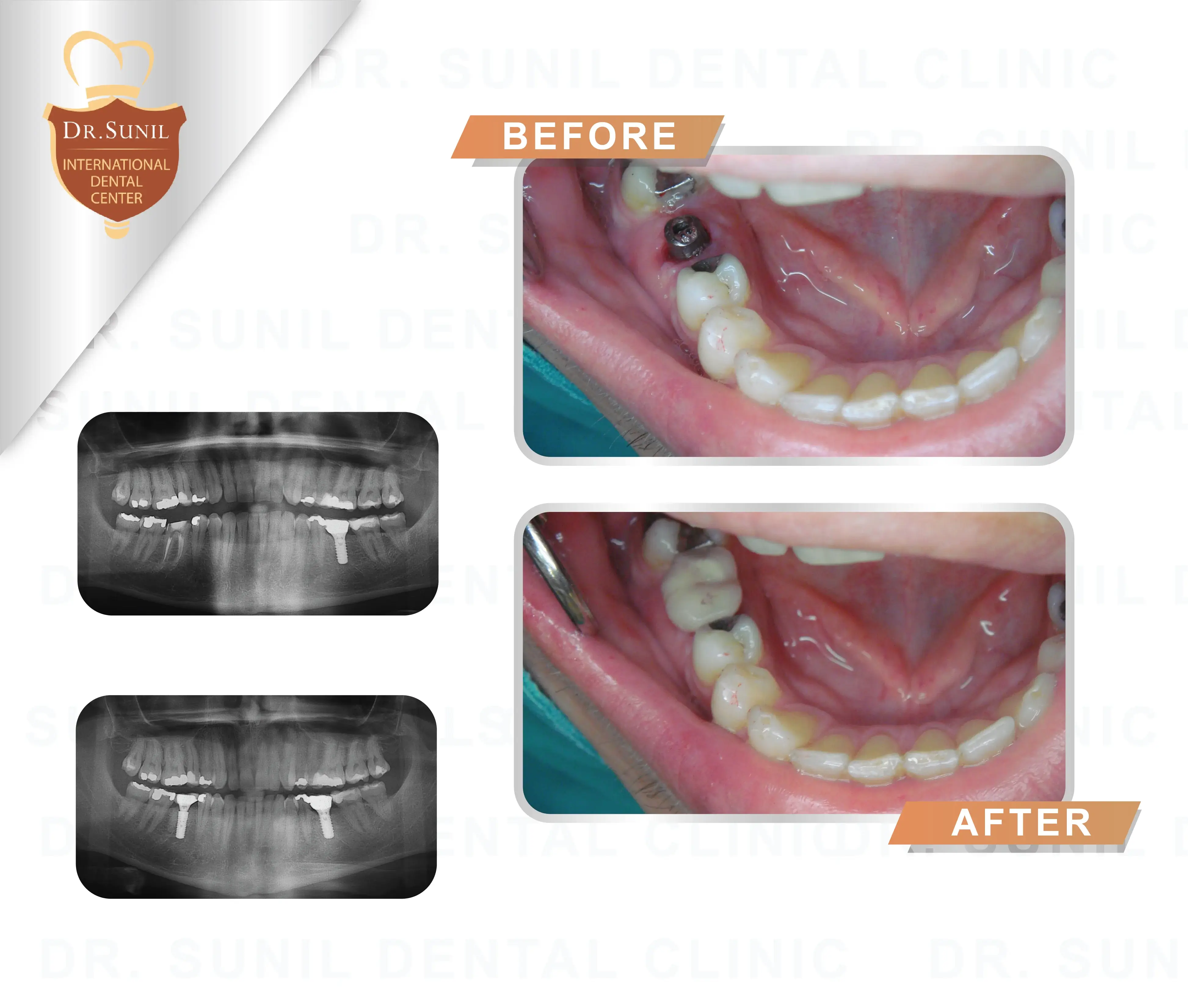 dental implant Thailand,tooth replacement case study,dental implant before after