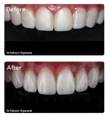After Treatment