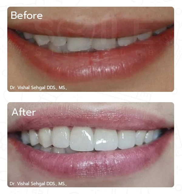 After Treatment