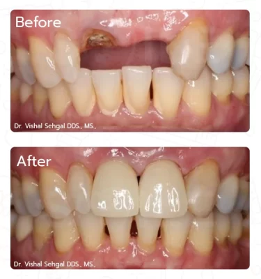 After Treatment