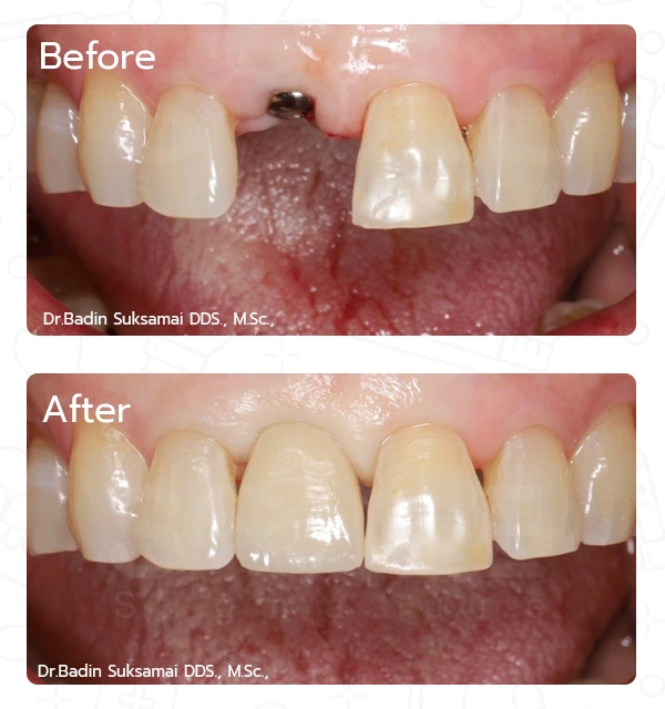 dental implant case,tooth replacement case study,implant dentistry,missing tooth restoration