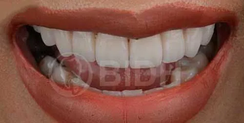 Thailand dental veneers case,porcelain veneers Bangkok,teeth veneer treatment Thailand