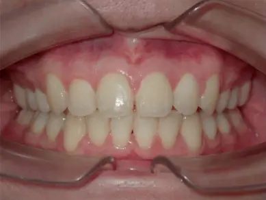 After Treatment