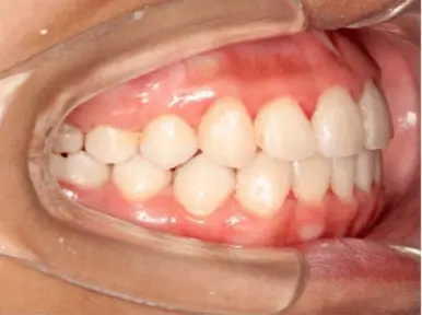 After Treatment