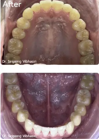 orthodontic case,teeth straightening,braces treatment,clear aligner case