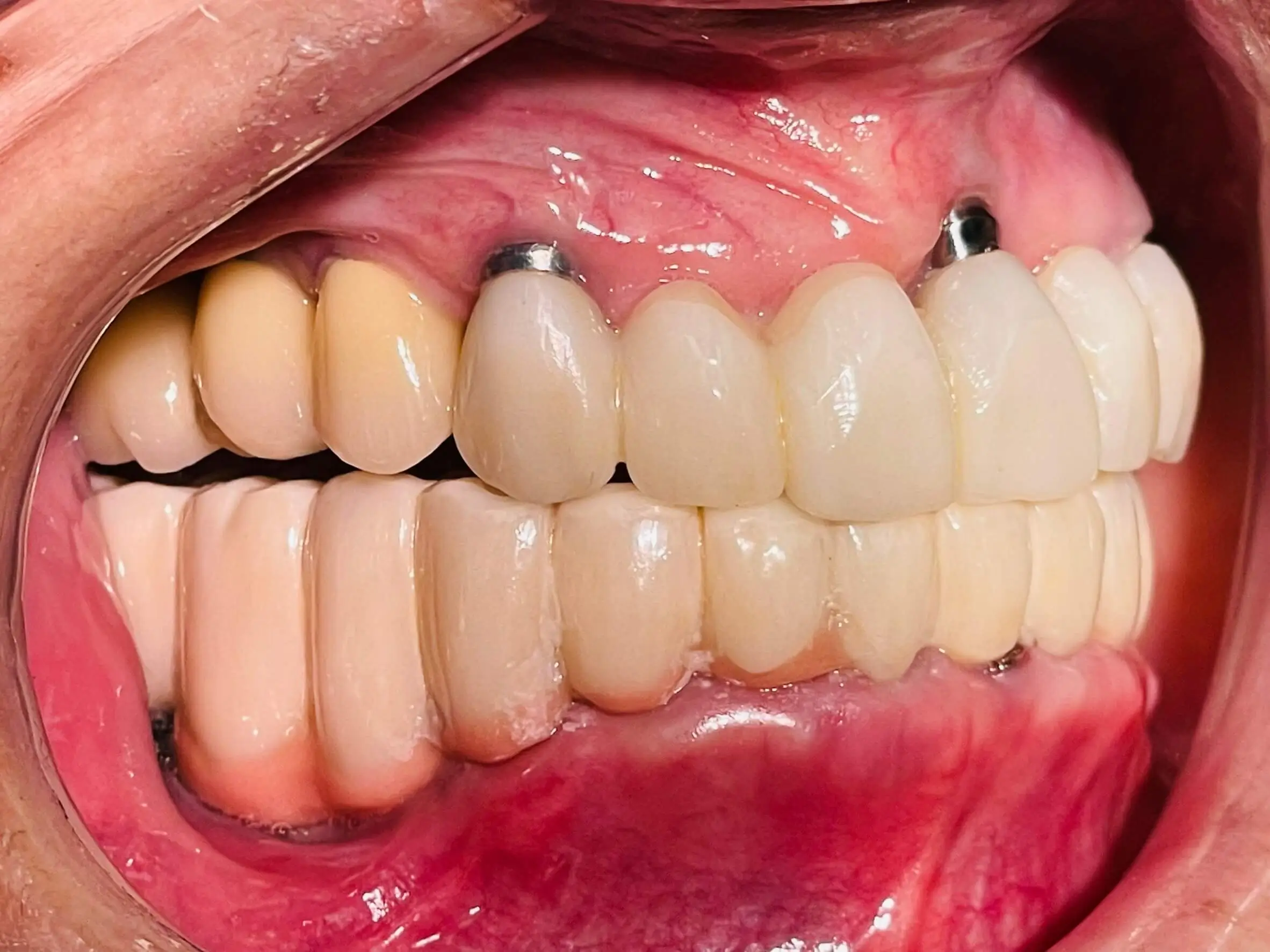 After Treatment