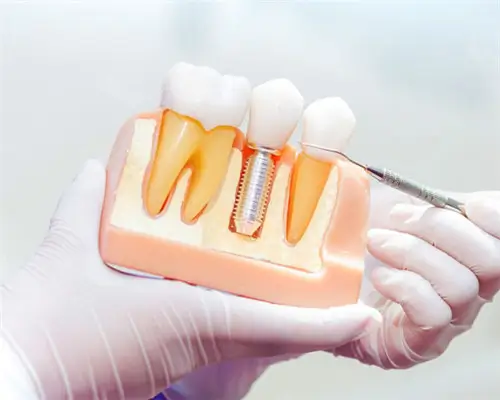 Confused Between Dental Implants and Bridges? Stop Choosing Blindly! A Dentist Reveals the Truth
