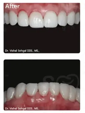 After Treatment