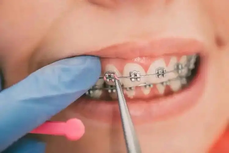 Fixed Orthodontic Treatment: Reliable Solutions for a Straighter Smile