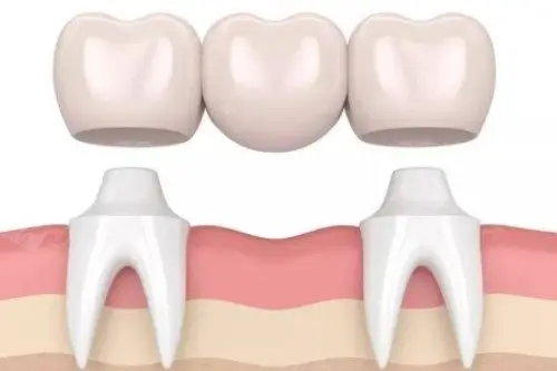 Confused Between Dental Implants and Bridges? Stop Choosing Blindly! A Dentist Reveals the Truth