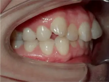Canine teeth correction,Orthodontic treatment for canines,Teeth straightening
