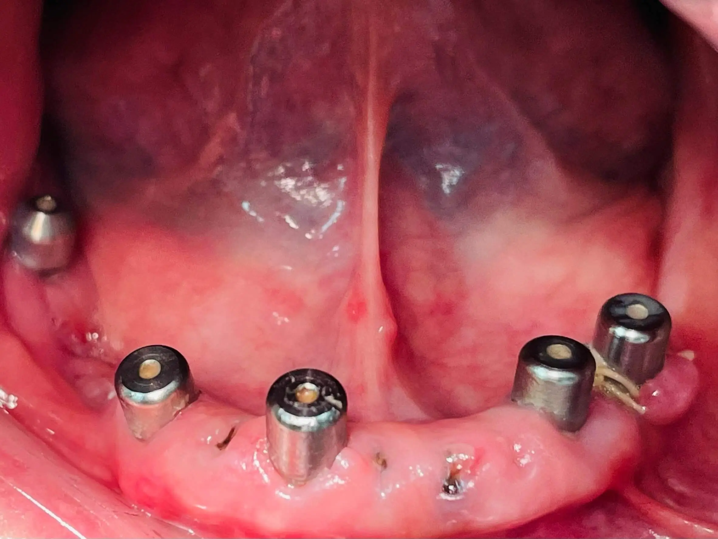 Treatment Details,Dental implant treatment cases