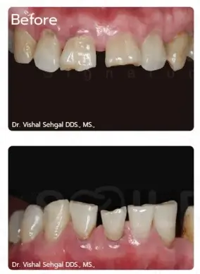 dental crown case,tooth restoration,crown treatment,cosmetic dentistry
