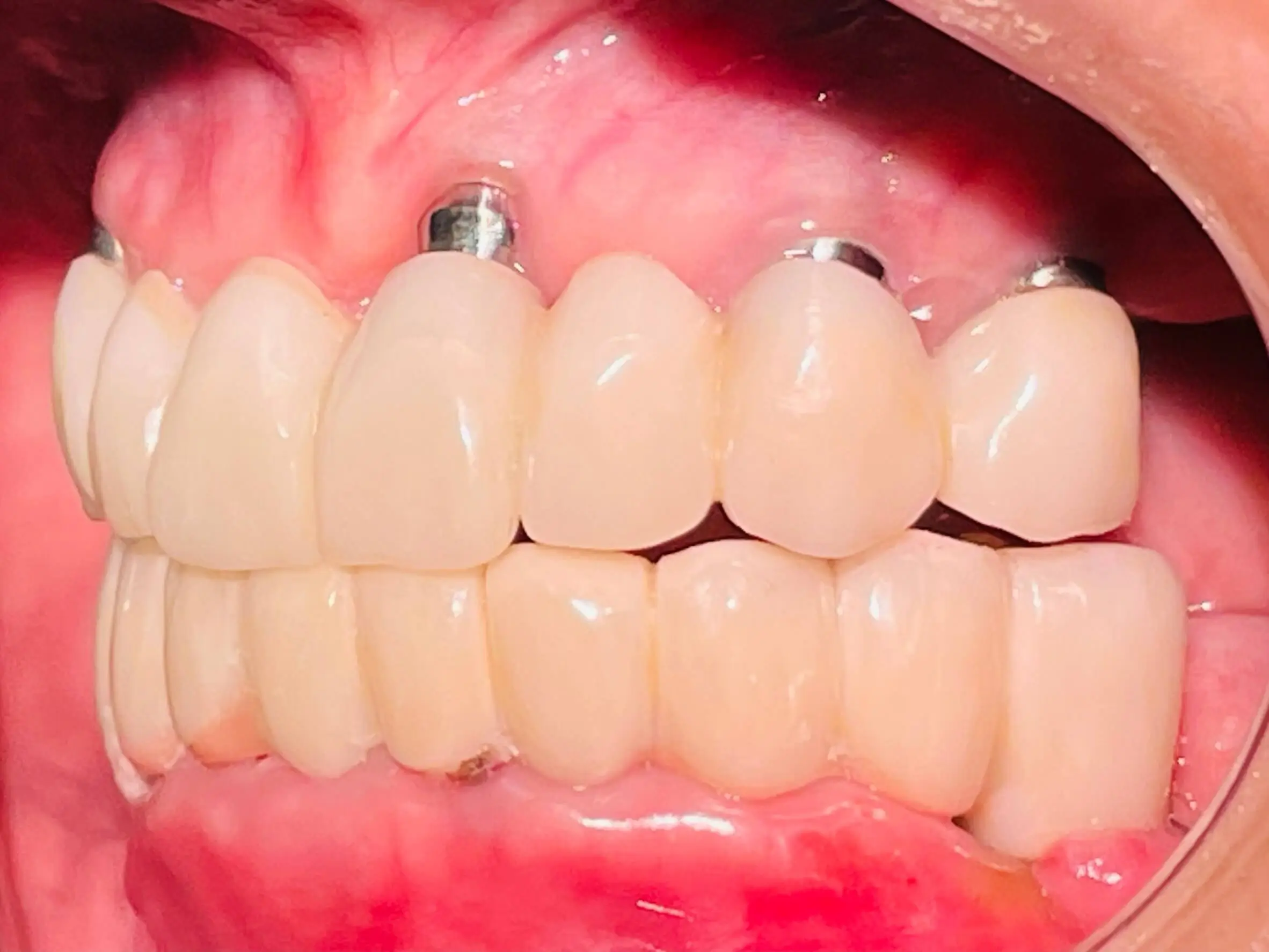 Dental Implant,Dental Implant Case