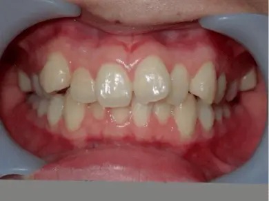 Orthodontic Treatment,Teeth straightening,Overbite correction
