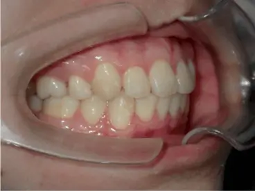 After Treatment