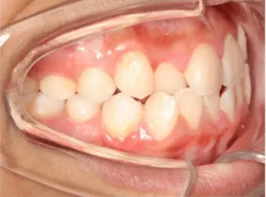 Orthodontic Treatment Details,Orthodontic  case