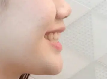 After Treatment