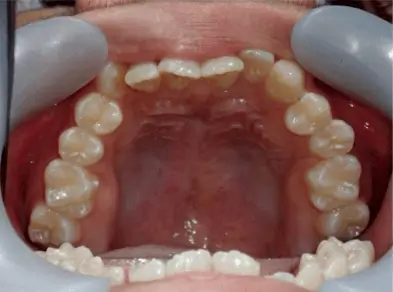 Inward front teeth correction,Orthodontic treatment for front teeth