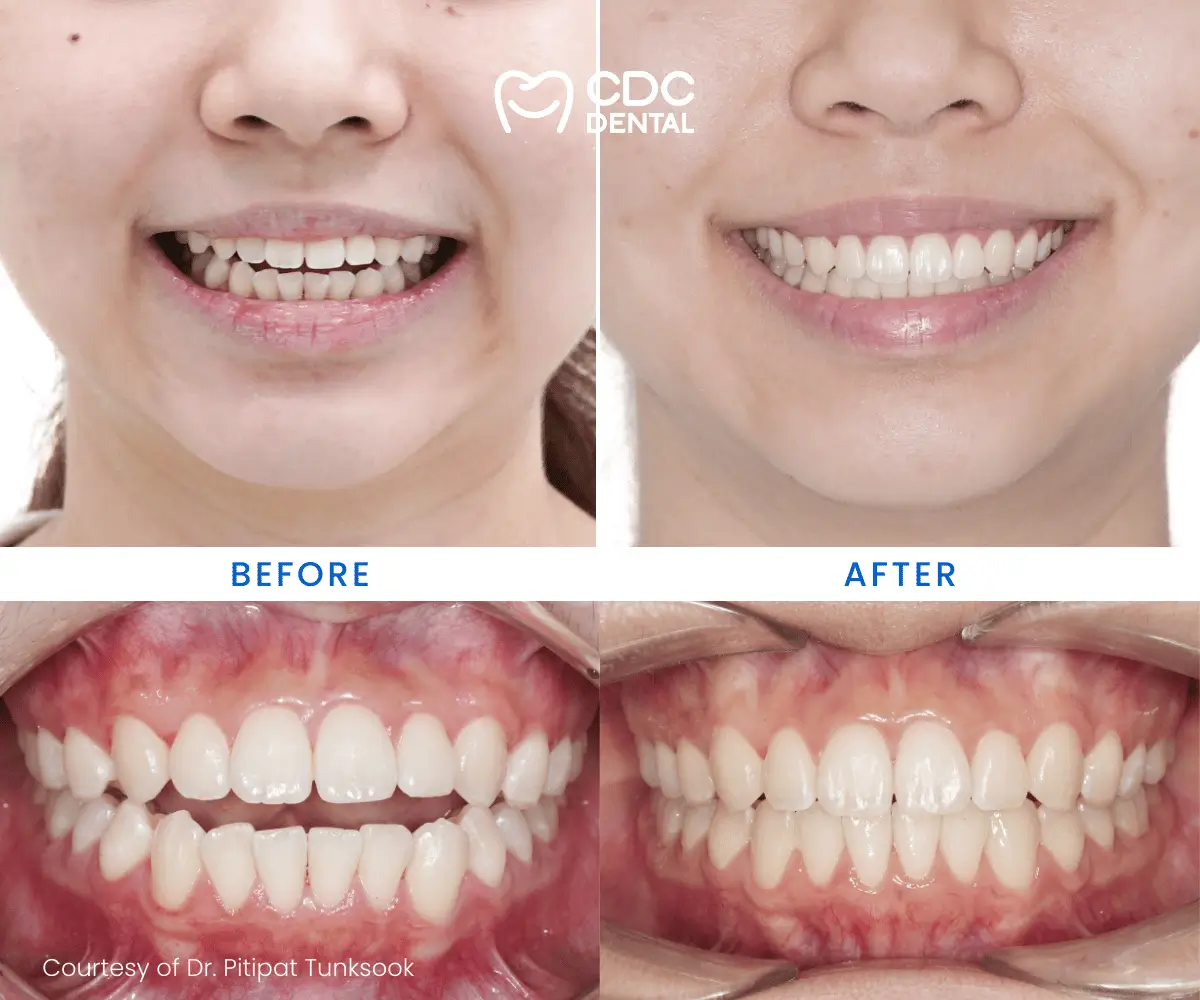 Before Treatment
