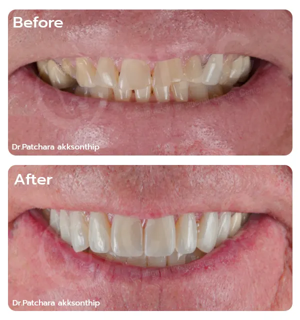 Before Treatment