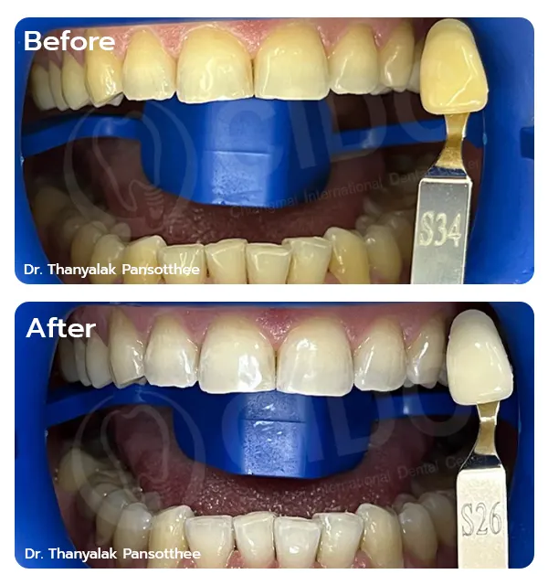 Before Treatment
