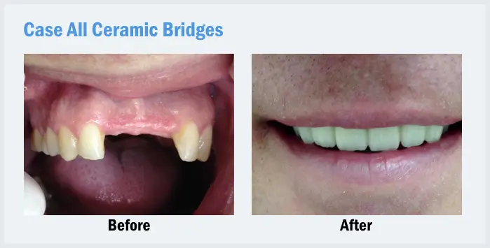 porcelain bridge Thailand,front teeth crown Thailand,porcelain dental bridge Thailand