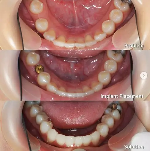 single dental implant Thailand,tooth implant Bangkok,implant treatment Thailand