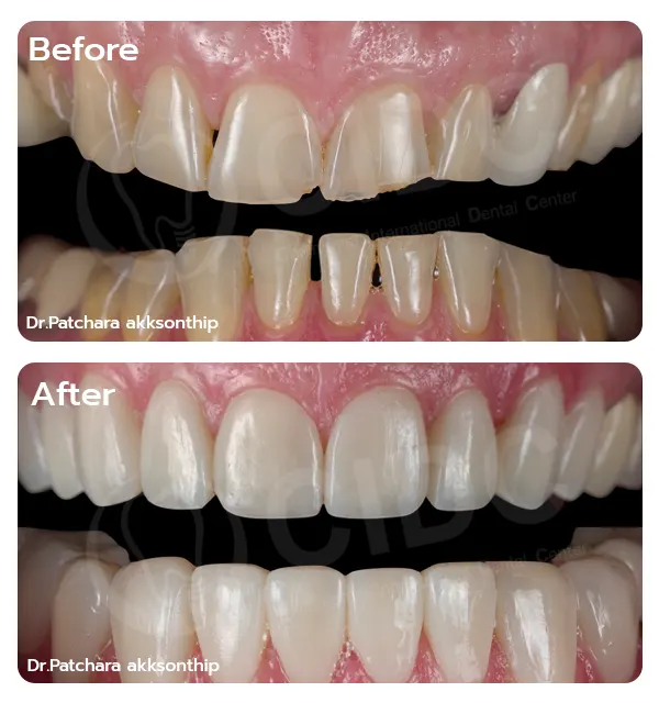 porcelain veneers Thailand,dental veneer case,smile makeover Thailand,Thailand dental clinic