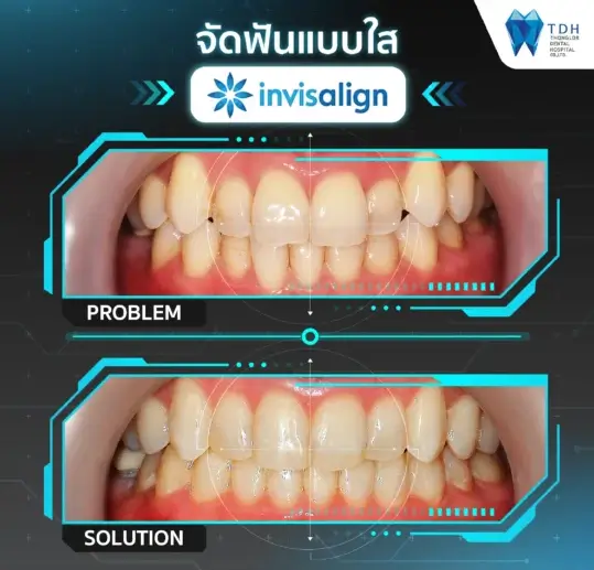 best Invisalign dentist Thailand,invisible braces Thailand,Invisalign smile transformation