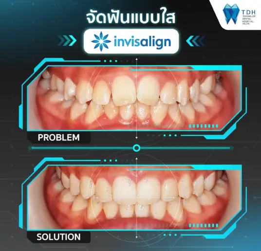 Invisalign Thailand,Invisalign treatment Bangkok,Invisalign smile correction