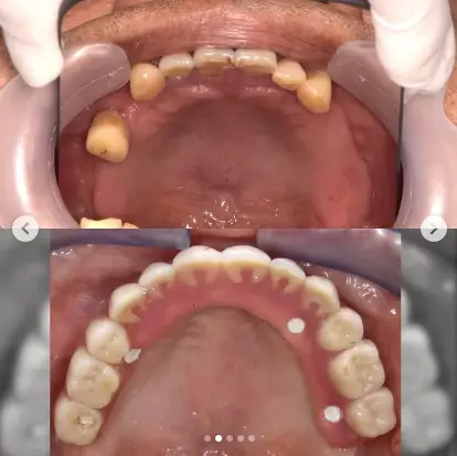 multiple dental implants Thailand,full mouth restoration Thailand,implant bridge Thailand