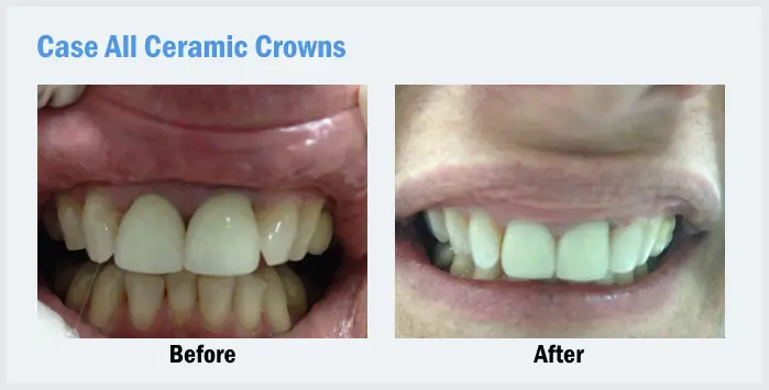 all ceramic crown Thailand,porcelain dental crown Thailand,cosmetic dental crown Bangkok