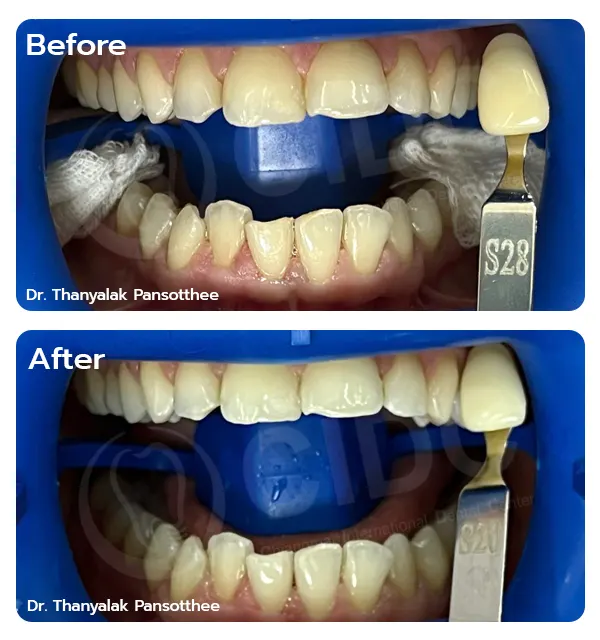 Before Treatment