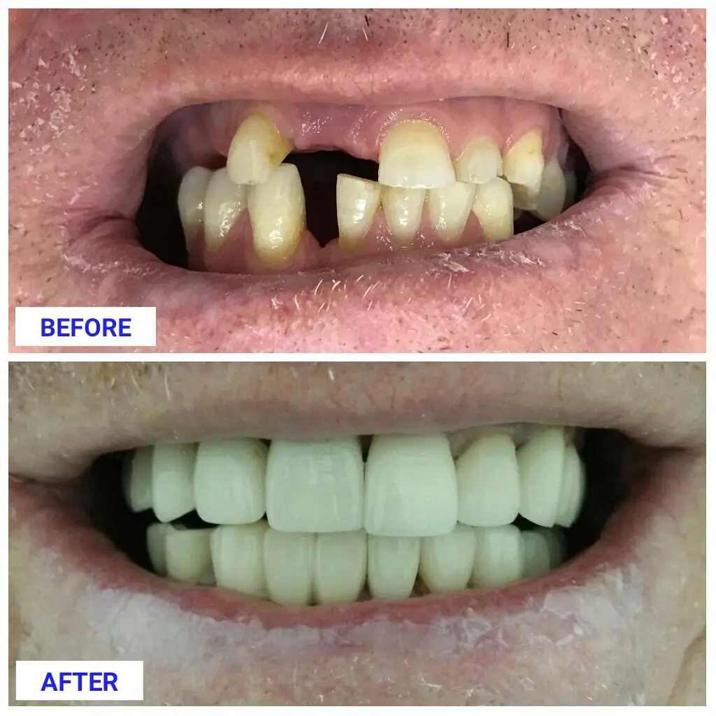 ront tooth implant Thailand,dental implant Bangkok,single tooth implant Thailand