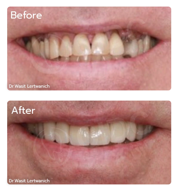 Before Treatment