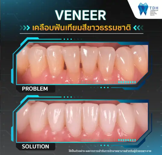 veneers Thailand,teeth whitening Thailand,cosmetic dental treatment Thailand