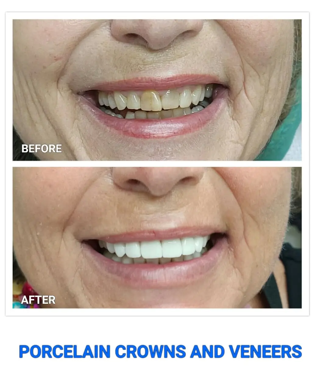 dental veneers Thailand,porcelain veneers Thailand,smile makeover Thailand