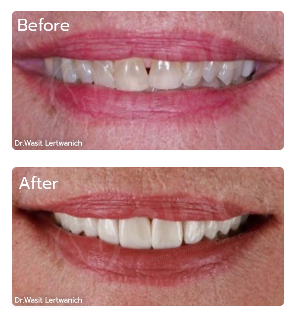 Before Treatment