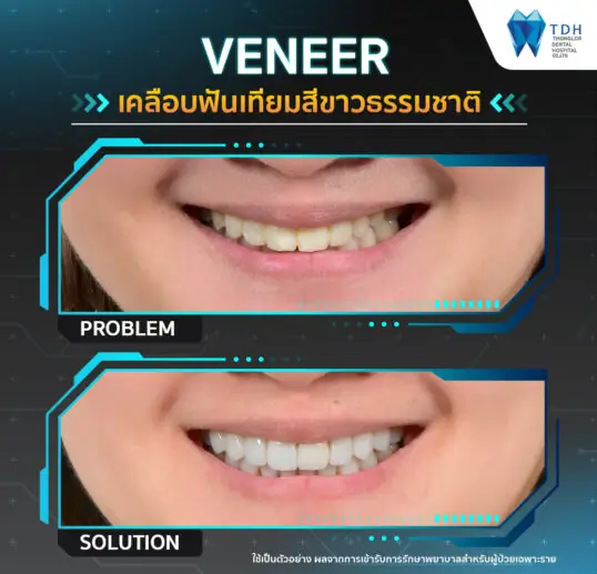 porcelain veneers Bangkok,smile makeover Thailand,dental veneers and whitening,best cosmetic dentist Thailand