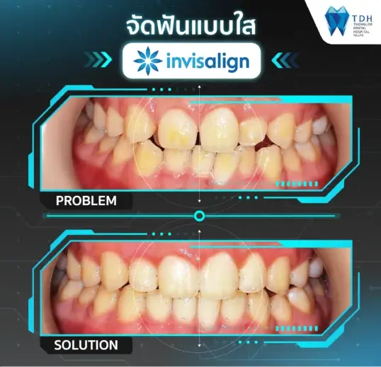 Invisalign Thailand,clear aligners Thailand,Invisalign dentist Bangkok,invisible braces Thailand