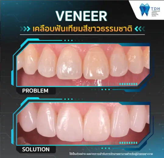 veneers Thailand,teeth whitening Thailand,porcelain veneers Bangkok,smile makeover Thailand